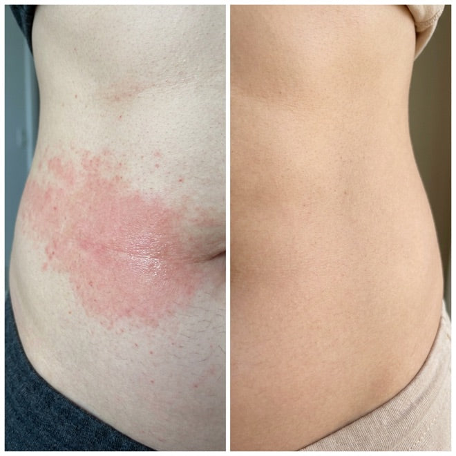 Belly fold, before and after