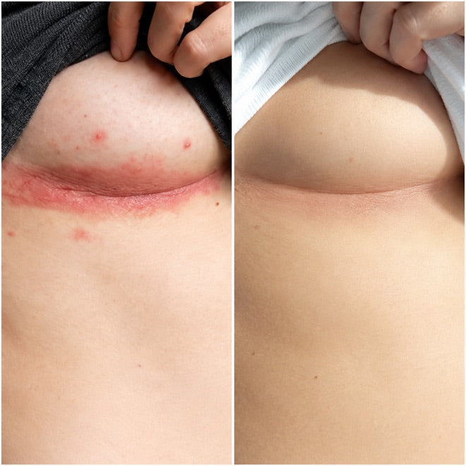 Under the breast, before and after