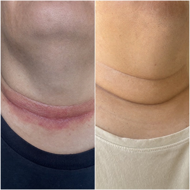 Neck fold, before and after