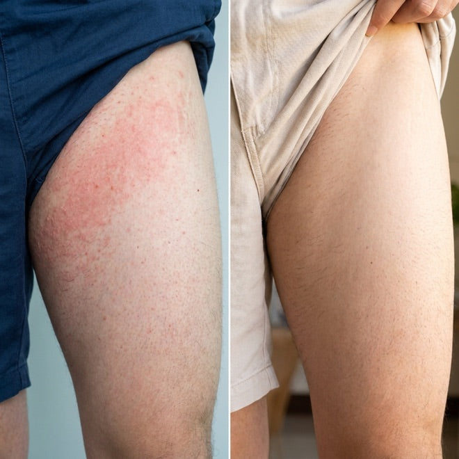 Inner thighs, before and after